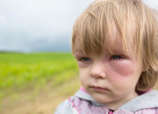 Lenfödem Nedir? Lenfödem Nedir?