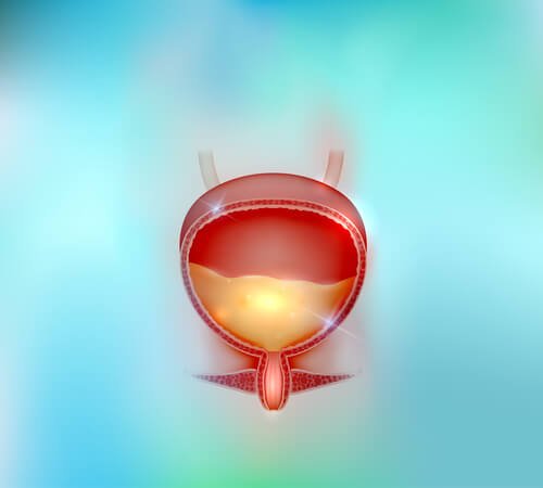 İdrar Yolları Taş Hastalıkları İdrar Yolları Taş Hastalıkları