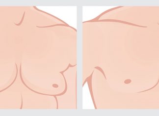 Jinekomasti Nedir? Jinekomasti Nedir?