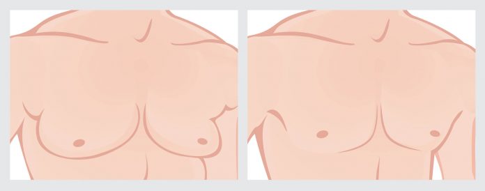 Jinekomasti Nedir? Jinekomasti Nedir?