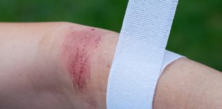 Yanık Tedavisi Çocuklarda Nasıl Yapılır