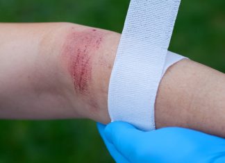 Yanık Tedavisi Çocuklarda Nasıl Yapılır? Yanık Tedavisi Çocuklarda Nasıl Yapılır