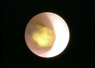 Sialendoskopi ile Tükürük Bezi Taşı Kırılması ve Çıkartılması Sialendoskopi ile Tükürük Bezi Taşı Kırılması ve Çıkartılması