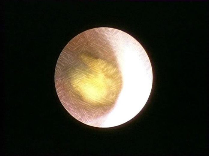 Sialendoskopi ile Tükürük Bezi Taşı Kırılması ve Çıkartılması