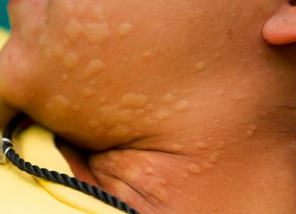 Ürtiker – Kurdeşen Ürtiker (Kurdeşen)