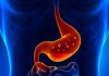 Gastroözofageal Reflü Nedir? Gastroözofageal Reflü Nedir?