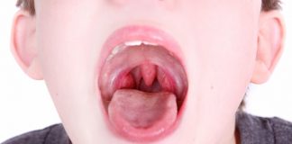 Bademcik İltihabı Bademcik İltihabı