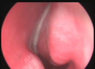 Çocuklarda Sinüzit Belirtileri Çocuklarda Sinüzit Belirtileri