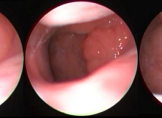 Geniz Eti Ameliyatı Ne Zaman Olmalı? Geniz Eti Ameliyatı Ne Zaman Olmalı