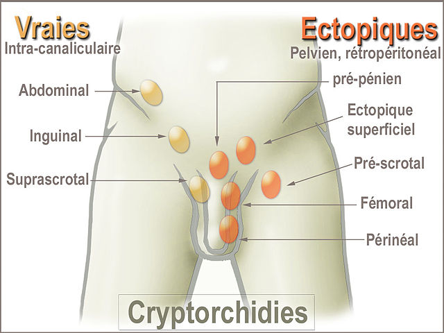 İnmemiş Testis Nedir İnmemiş Testis Nedir