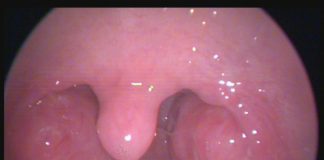 Bademcik Ameliyatından Sonra Nelere Dikkat Etmeliyiz? Bademcik Ameliyatından Sonra Nelere Dikkat Etmeliyiz