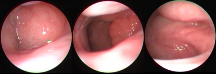 Çocuklarda Endoskopik Geniz Eti Muayenesi Çocuklarda Endoskopik Geniz Eti Muayenesi