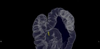 Kolon Kanseri - Kalın Bağırsak Kanseri