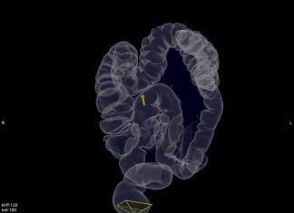 Kolon Kanseri – Kalın Bağırsak Kanseri Kolon Kanseri - Kalın Bağırsak Kanseri