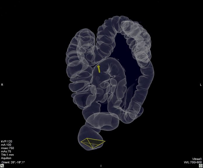 Kolon Kanseri - Kalın Bağırsak Kanseri Kolon Kanseri - Kalın Bağırsak Kanseri