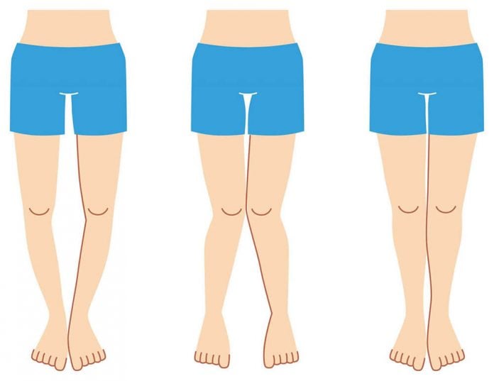 carpik-bacak-romatizma-meniskus-diz