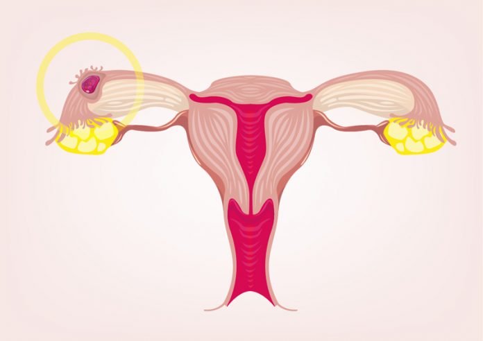 dış gebelik dış gebelik