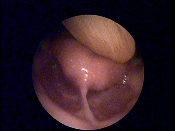 Bebeklerde Dil Bağı Bebeklerde Dil Bağı