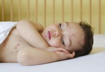 Altıncı Hastalık Nedir? Altıncı Hastalık Nedir