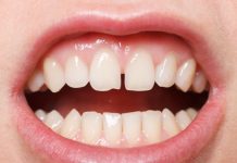 Diş Çekim Boşluğu Nasıl Tedavi Edilir? Diş Çekim Boşluğu Nasıl Tedavi Edilir