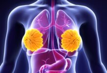 Kadınlarda Meme Sarkması ve Çözüm Önerileri Kadınlarda Meme Sarkması ve Çözüm Önerileri