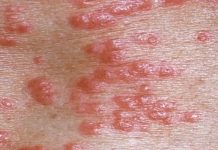 Uyuz Belirtileri Uyuz Belirtileri