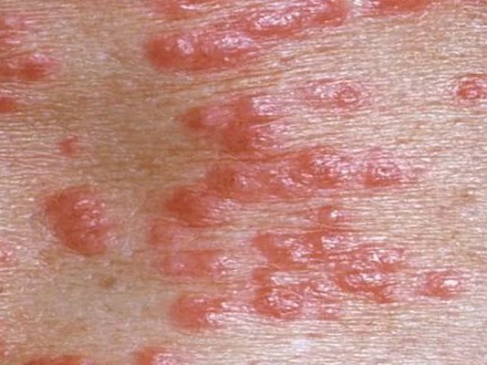 Uyuz Belirtileri Uyuz Belirtileri