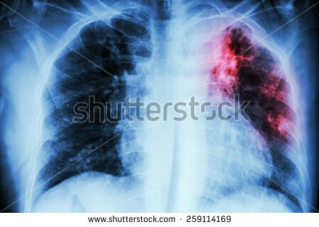 Tüberküloz (Verem) Tanısında Yenilikler Tüberküloz (Verem) Tanısında Yenilikler