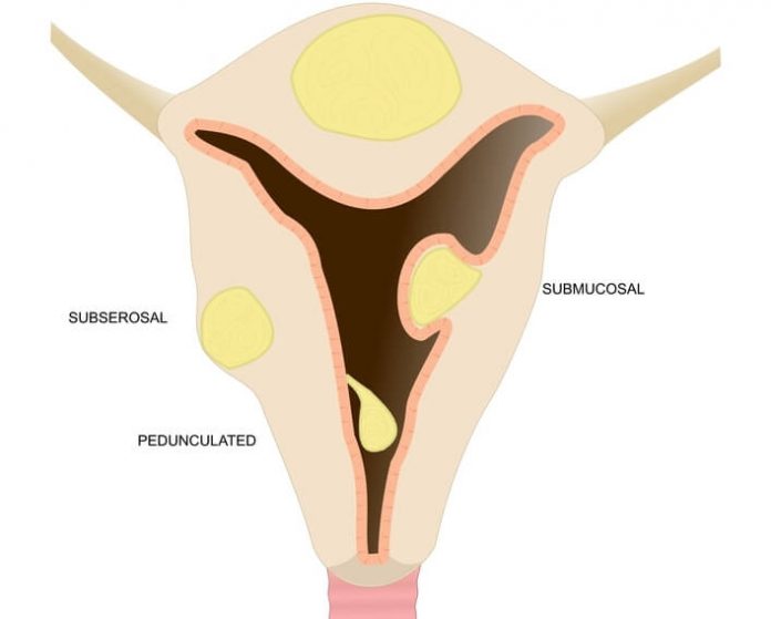 Laparoskopik Miyom Laparoskopik Miyom