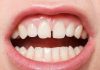 Diş Eti Çekilmesi Dişler Arası Boşluklar