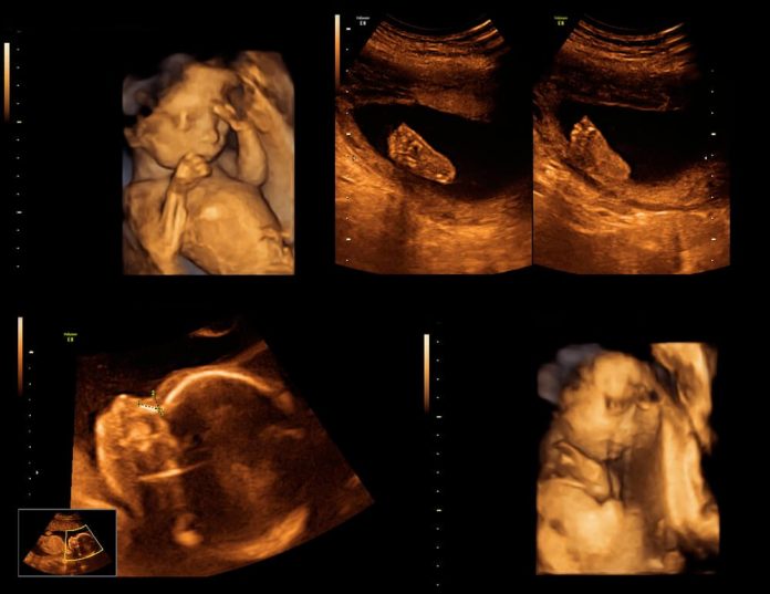 Ayrıntılı Ultrason Ne İşe Yarar Ayrıntılı Ultrason Ne İşe Yarar