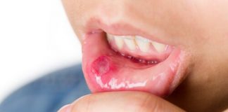 Aft – Ağız Yarası Aft - Ağız Yarası