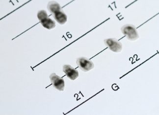 Down Sendromu Nedir, Neden Olur? Down Sendromu Nedir, Neden Olur