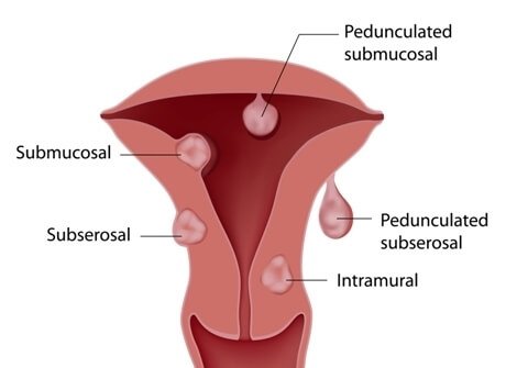 Hamilelikte Miyom Hamilelikte Miyom