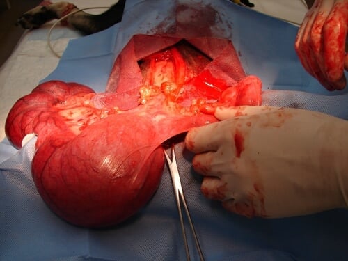 Miyom Ameliyatında Rahim Alınması Gerekir mi? Miyom Ameliyatında Rahim Alınması Gerekir mi