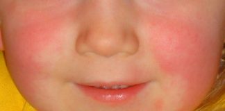 Kızıl Hastalığı Kızıl Hastalığı