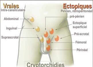 İnmemiş Testis inmemiş testis