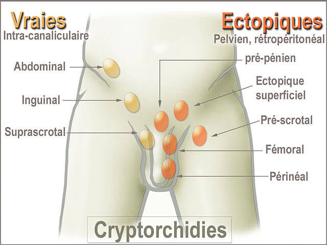 inmemiş testis inmemiş testis