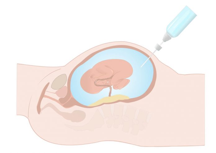 Prenatal Tanı Yöntemleri Prenatal Tanı Yöntemleri