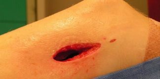 Artrit - Osteomiyelit