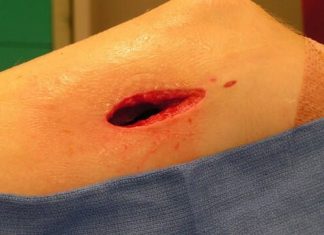 Artrit – Osteomiyelit Artrit - Osteomiyelit