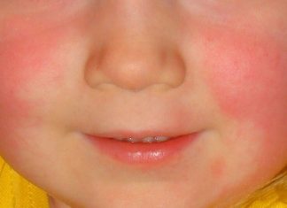 Kızıl Hastalığı Kızıl Hastalığı