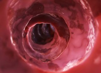 Crohn Hastalığı Crohn Hastalığı